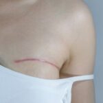 Breast Surgeon in Pune